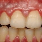 Gum disease, Gingivitis or Periodontitis